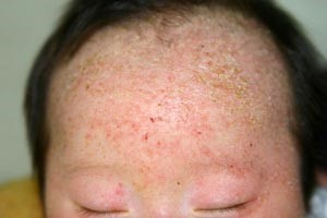 脂漏性湿疹の原因